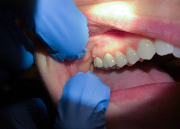 Best Emergency Wisdom Teeth Removal in Kenneth City, FL